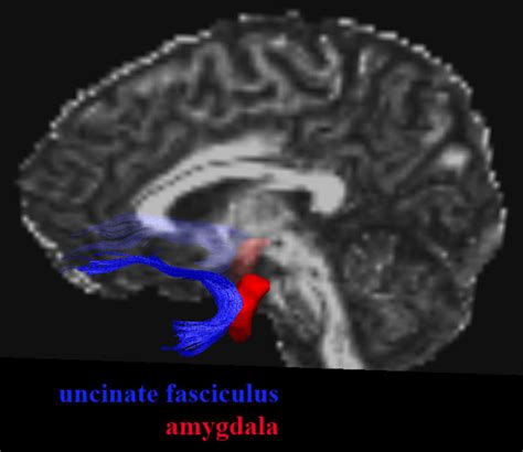 Topography of the uncinate fasciculus and amygdala. Example of their... | Download Scientific ...