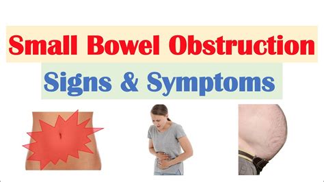 Small Bowel Obstruction (SBO) Signs & Symptoms, & Why They Occur - YouTube