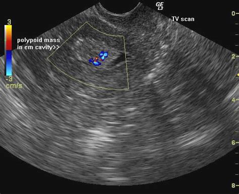 A Gallery of High-Resolution, Ultrasound, Color Doppler & 3D Images - carcinoma