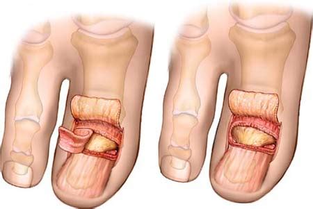 Nail Bed Ablation Surgery - Nail Ftempo