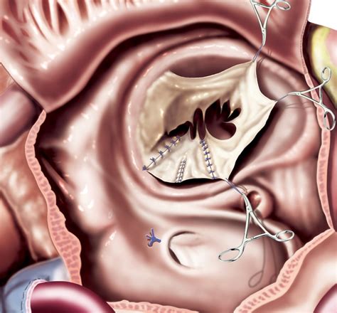 Mitral Valve Repair: The Evolution of Transcatheter Implantation