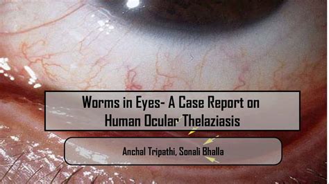 Worms in Eyes- A Case Report on Human Ocular Thelaziasis - YouTube