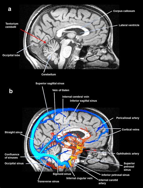 Cureus | Tentorium Cerebelli: the Bridge Between the Central and Peripheral Nervous System, Part 2