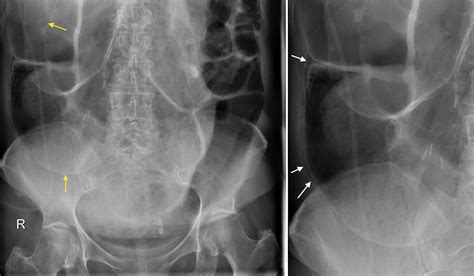 Pneumatosis intestinalis - Radiology at St. Vincent's University Hospital