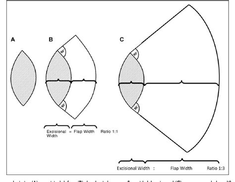 Figure 6 from The Keystone Flap—A Case Series Demonstrating Practical ...