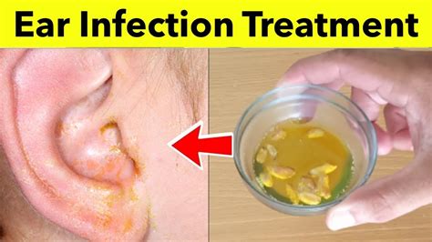 How to Cure Ear Infection Naturally at Home | Best Home Remedies for Ear Infection Treatment ...