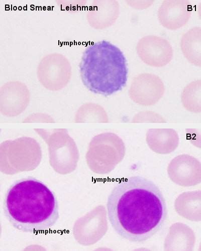 Small vs Large lymphocytes | Medical Laboratories