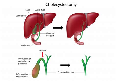 Laparoscopic surgery. Technical surgery which operations are performed ...