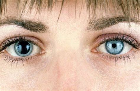 What Is Anisocoria: Causes and Treatments - Vision Center