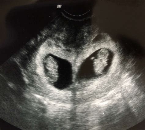 Why Does My Ultrasound Look Like Twins at Janet Haglund blog