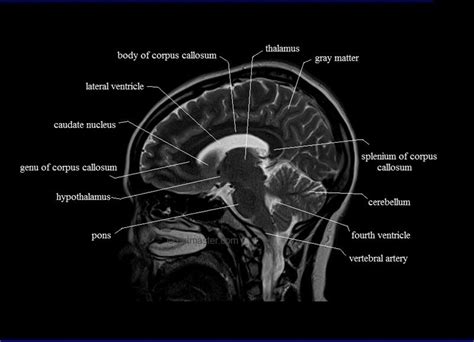 Brain Anatomy Mri Sagittal View