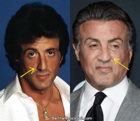 Sylvester Stallone Plastic Surgery Comparison Photos