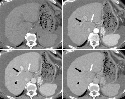 Ct Liver 4 Phase - tacitceiyrs