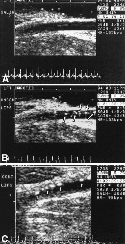 Molecular Imaging of Inflammation and Intraplaque Vasa Vasorum ...