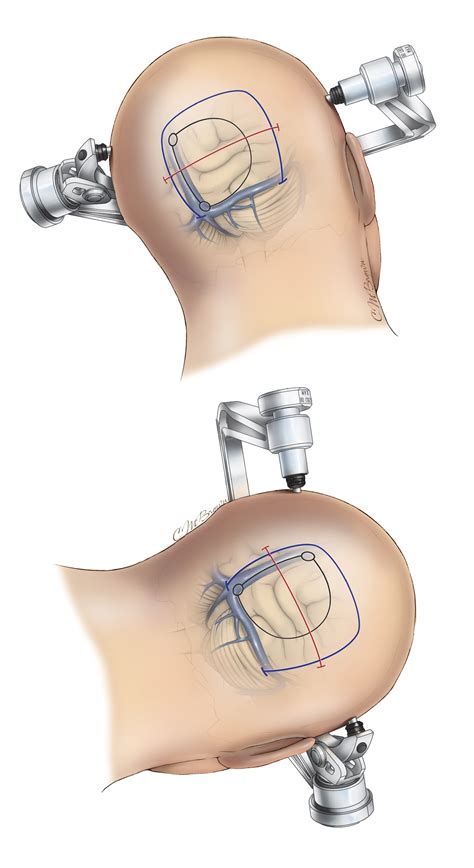 Occipital Craniotomy | The Neurosurgical Atlas, by Aaron Cohen-Gadol, M.D.