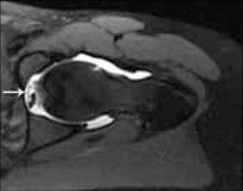 Anterior synovial herniation pit of the femoral head with a resultant ...