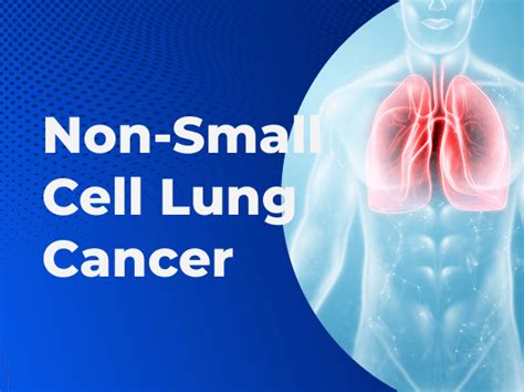 Non-Small Cell Lung Cancer - NSCLC Causes, Symptoms and Treatment