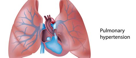 Pulmonary Artery Hypertension