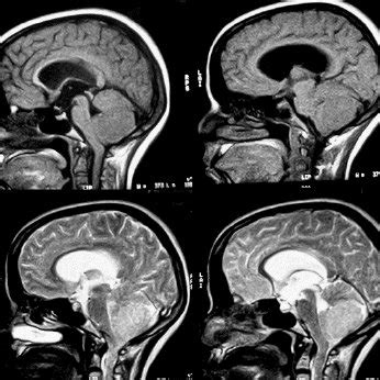 Schematic drawing of the duplicated falx cerebelli and occipital sinus ...