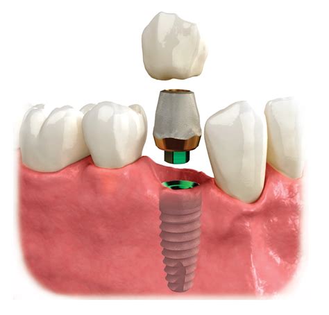 Implant with Crown Rocky Mount NC | DentureCare and Implant Solutions