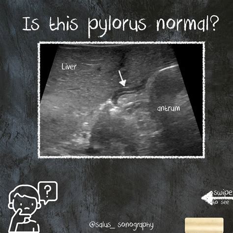 ⚜️SONOGRAPHIC MEASUREMENTS OF A NORMAL... - Salus sonography