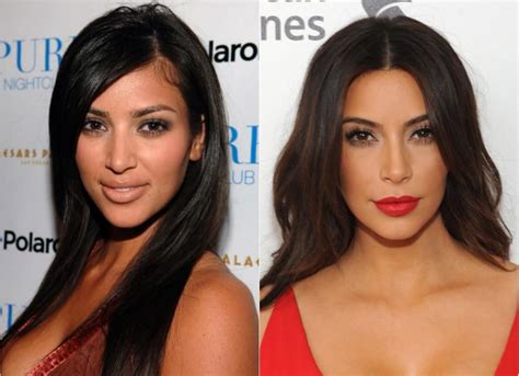 Celebrity Plastic Surgery: 30 Before-and-After Pics | Kardashian plastic surgery, Celebrity ...