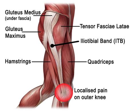 What Works for Irritating IT Band Syndrome? | Tampa Bay Sports ...