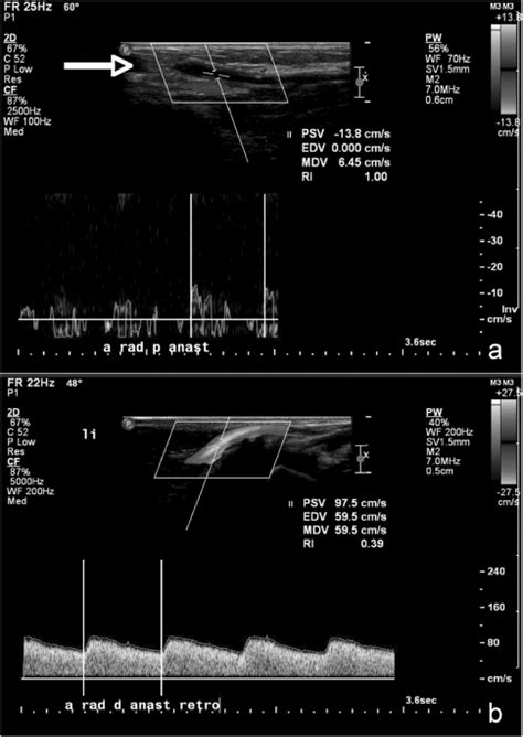 Duplex sonography of the radiocephalic fistula. (A) Stenosis in... | Download Scientific Diagram