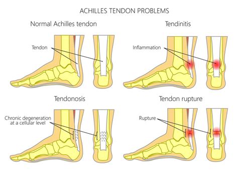 Achilles tendinopathy - Ultrasound Guided Injections