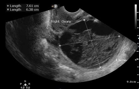 Hemorrhagic ovarian cyst | Radiology Case | Radiopaedia.org