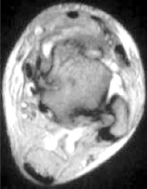 Injury (incomplete rupture) of anterior talofibular ligament | Download Scientific Diagram