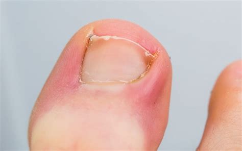 How to Treat an Infected Ingrown Toenail - MVS Podiatry Associates