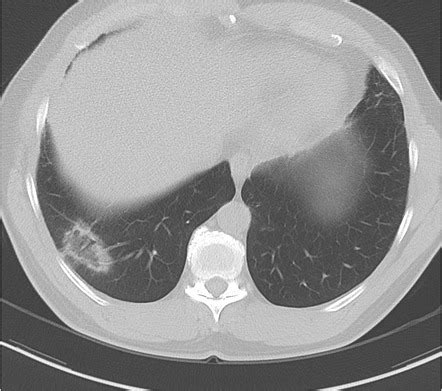 Atoll sign (lungs) | Radiology Reference Article | Radiopaedia.org