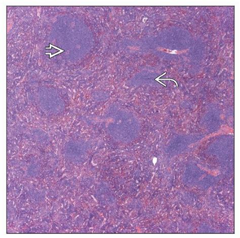 Chronic Lymphocytic Leukemia/Small Lymphocytic Lymphoma | Basicmedical Key