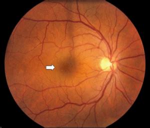 A Detailed Study on Cystoid Macular Oedema, Diagnosis, Treatment