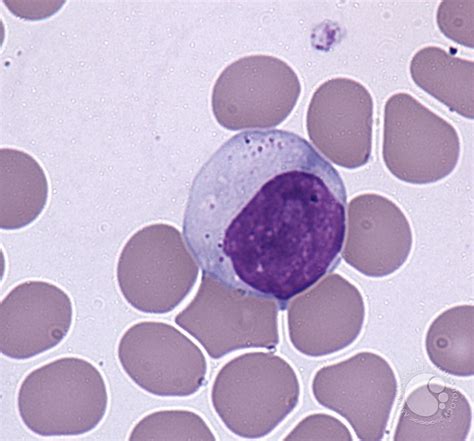 Large granular lymphocytes - 1.