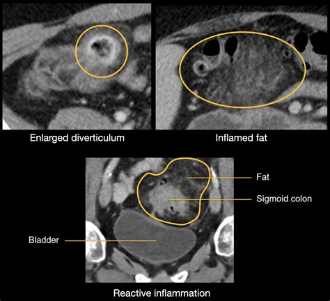 Abdominal CT: diverticulitis • LITFL • Radiology Library