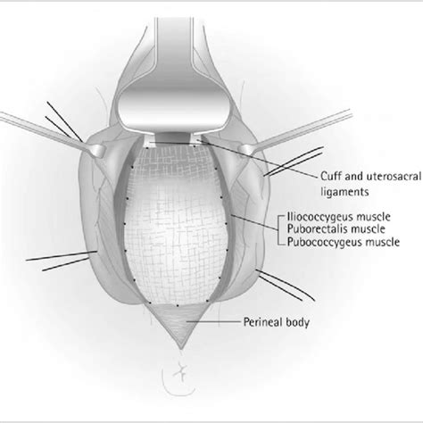 Anterior repair with mesh/graft. The material is secured to the arcus... | Download Scientific ...