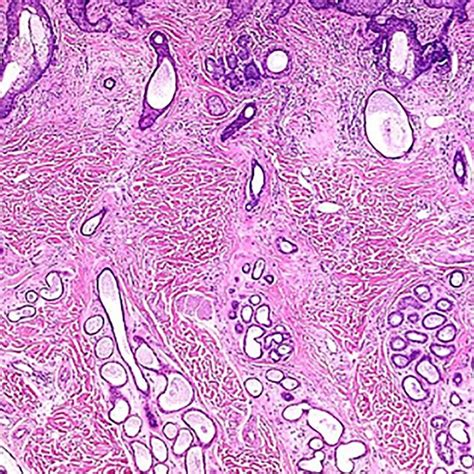 Histology of folliculosebaceous cystic hamartoma: numerous sebaceous... | Download Scientific ...