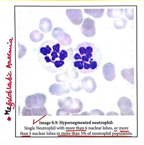 Hypersegmented Neutrophils - Megaloblastic anaemia ... ( Note ...