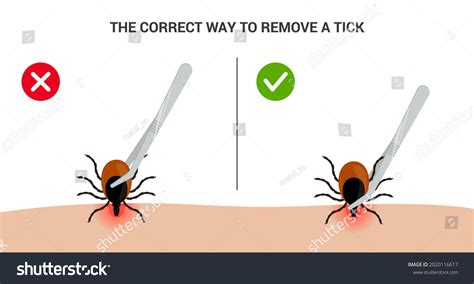 Correct Way Remove Tick Insect Correctly Stock Vector (Royalty Free ...