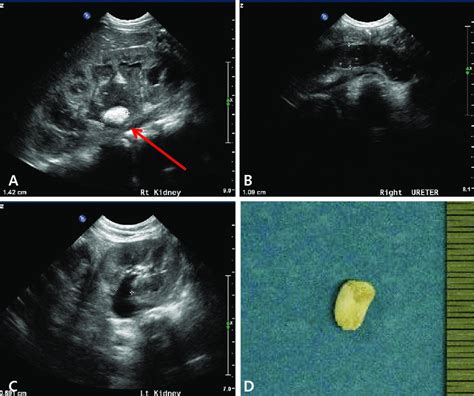 Kidney Stone Ultrasound