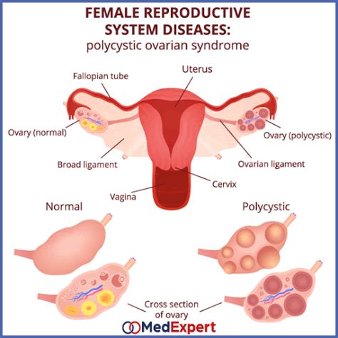 Types Of Infertility In Females - Ziva Fertility