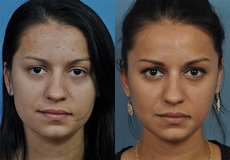 Dermabrasion Before and After Pictures Jacksonville, FL