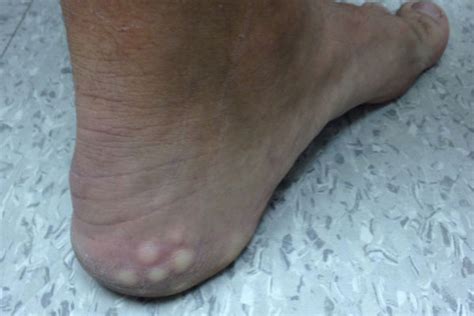 Derm Dx: White lumps on the heel when standing - Clinical Advisor