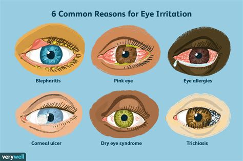 Top 6 Reasons for Eye Irritation