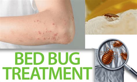 Facts You Need Know About The Bed Bug Treatment | by Hello PestControl | Medium