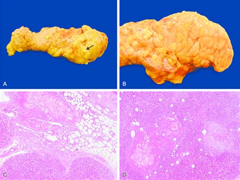 A -Gross examination of the pancreas showing acute edematous... | Download Scientific Diagram