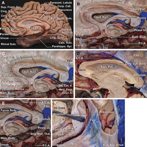 Corpus Callosotomy | The Neurosurgical Atlas