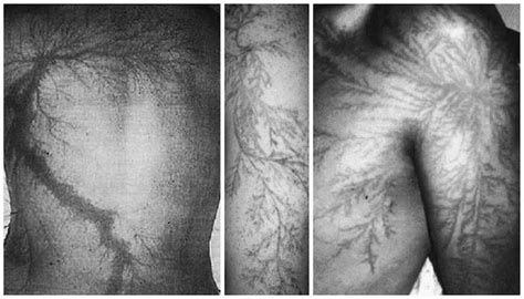 Lichtenberg figure scarring.......this makes me wanna get hit by lightning | Lichtenberg figures ...